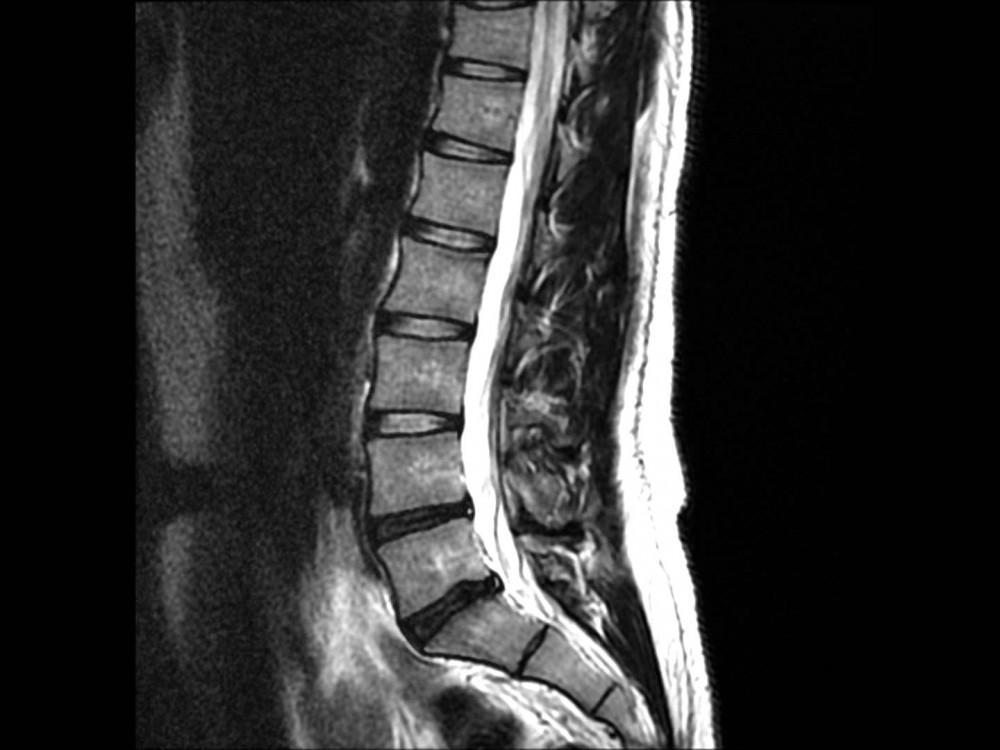 MRI lumbar spine, Low Back Pain