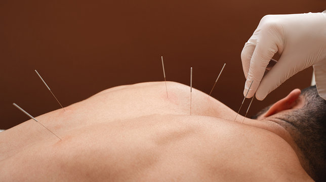 acupuncture