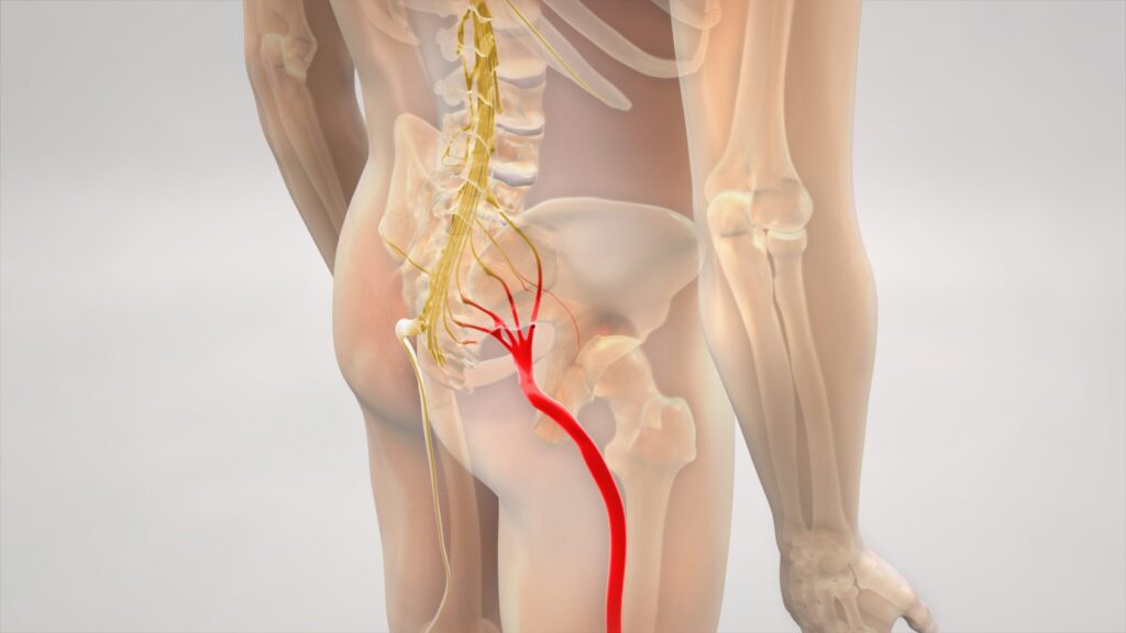 Sciatica Nerves